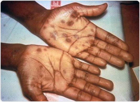 Secondary stage syphilis sores (lesions) on the palms of the hands. Referred to as